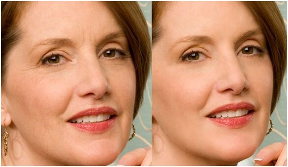 преди и след подмладяване на плазмената кожа на лицето