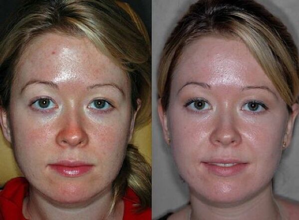 снимки преди и след процедурата за подмладяване на плазмата