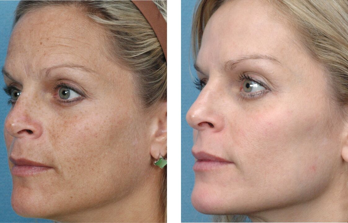 преди и след подмладяване на кожата снимка 1