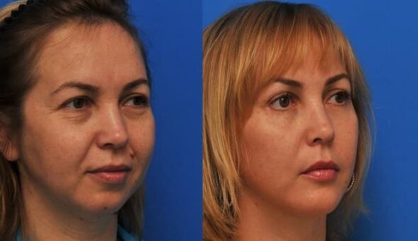 преди и след подмладяване на кожата със стягаща снимка 1
