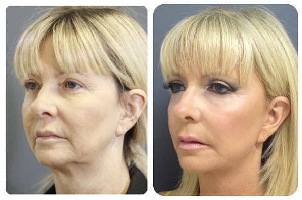 преди и след подмладяване на кожата със стягаща снимка 2