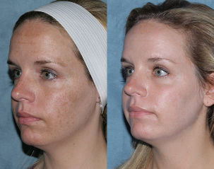 Снимки преди и след фракционного подмладяване на лицето