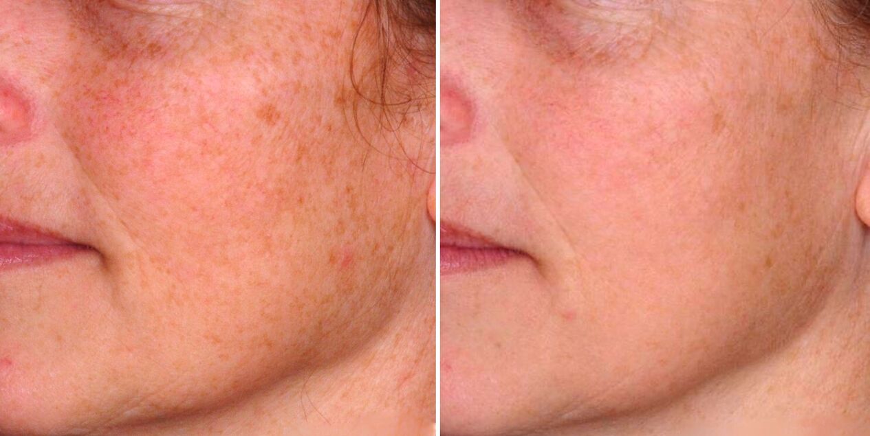 Резултатът от фракционната фототермолиза е намаляването на старческите петна по кожата на лицето. 