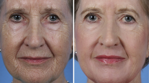 частично подмладяване на лицето преди и след снимки