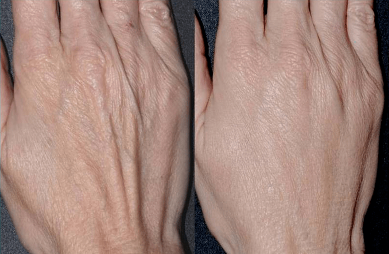 контурна пластмаса, подмладяване на ръце снимка 2 преди и след