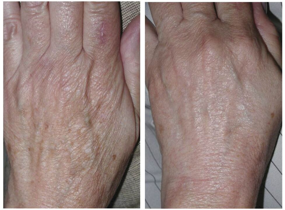 лазерно подмладяване на ръцете преди и след снимки